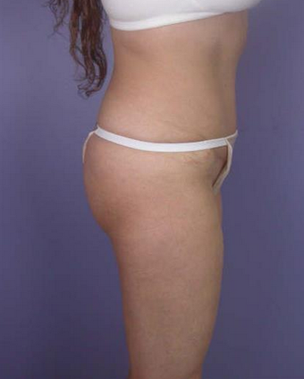 45-54 year old woman treated with Butt Lift before 1677511