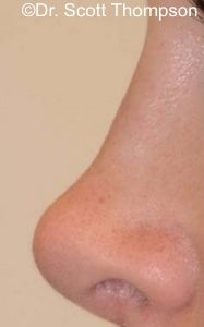 Revision Rhinoplasty Surgery 825551
