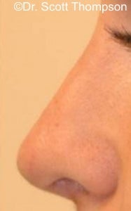 Revision Rhinoplasty Surgery 825551