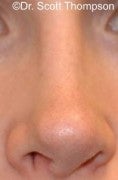 Revision Rhinoplasty Surgery before 825551
