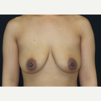 35-44 year old woman treated with Breast Lift with Implants before 3305235