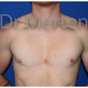 18-24 year old man treated with FTM Chest Masculinization Surgery after 3829023