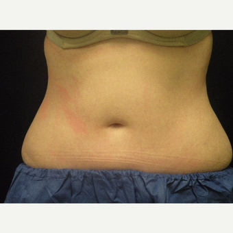 25-34 year old woman treated with CoolSculpting after 3680234