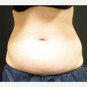 25-34 year old woman treated with CoolSculpting before 3680234