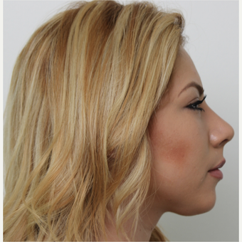 18-24 year old woman treated with Rhinoplasty after 3371516