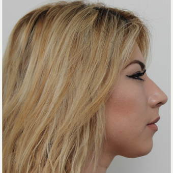 18-24 year old woman treated with Rhinoplasty before 3371516