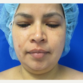 Chin Liposuction before 3141671
