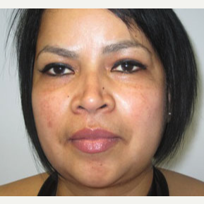 Chin Liposuction after 3141671