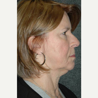 63 year old woman treated with Facelift before 3710755