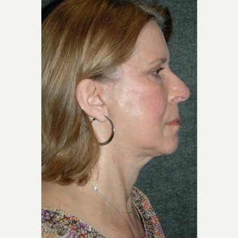 63 year old woman treated with Facelift after 3710755
