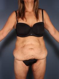After Weight Loss, Tummy Tuck before 1394244