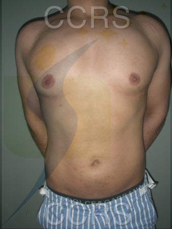 VASER Lipo - 28 yrs. old male (abdomen, back & chest) after 636089