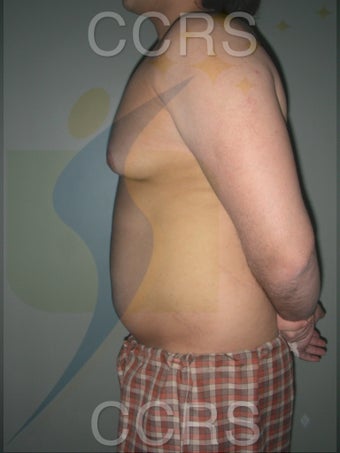 VASER Lipo - 28 yrs. old male (abdomen, back & chest) 636089