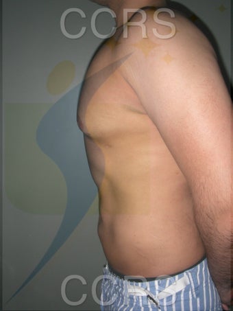 VASER Lipo - 28 yrs. old male (abdomen, back & chest) 636089