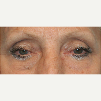 55-64 year old woman treated with Eye Bags Treatment after 3811434