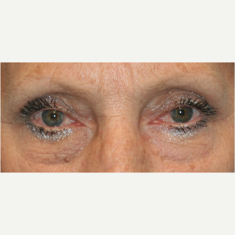 55-64 year old woman treated with Eye Bags Treatment before 3811434