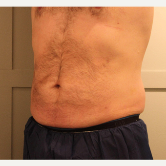 45-54 year old man treated with Liposuction after 3218445