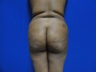 26 Year Old, Brazilian Butt Lift, Butt Augmentation with Fat Grafting before 1118277