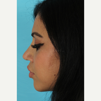 25-34 year old woman treated with Rhinoplasty after 3691332
