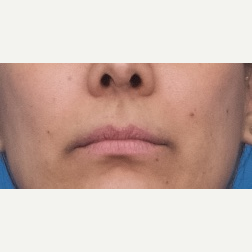 25-34 year old woman treated with Restylane Silk before 3764116