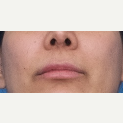 25-34 year old woman treated with Restylane Silk after 3764116