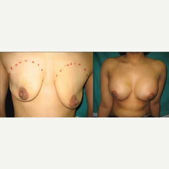 25-34 year old woman treated with Breast Augmentation after 2397174