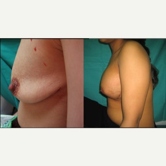 25-34 year old woman treated with Breast Augmentation before 2397174
