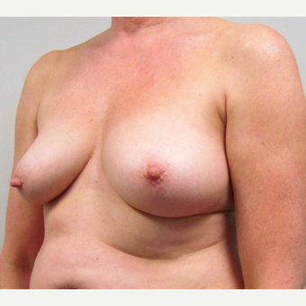 Breast Lift for this 55 Year Old Woman before 3791717