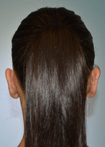 Otoplasty 1351670