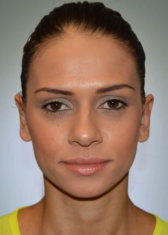 Otoplasty after 1351670