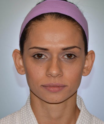 Otoplasty before 1351670