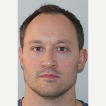 35-44 year old man treated with Sinus Surgery after 3440678