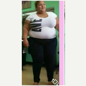 35-44 year old woman treated with Sleeve Gastrectomy before 2473011