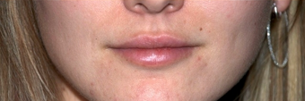 Lip Augmentation - Juvederm after 261422