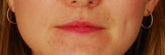 Lip Augmentation - Juvederm before 261422