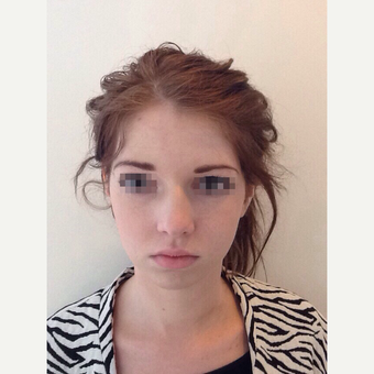 18-24 year old woman treated with Rhinoplasty before 3122792