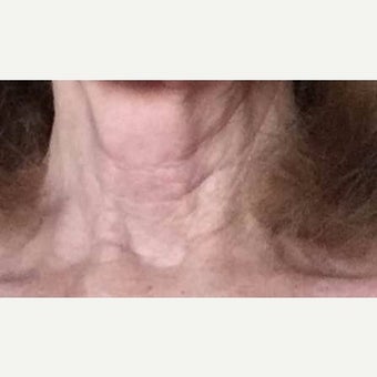 65-74 year old woman treated with Kristine Romine MD Neck Renewal Cream. before 2014644