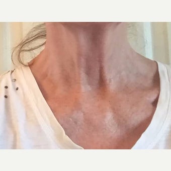 65-74 year old woman treated with Kristine Romine MD Neck Renewal Cream. after 2014644