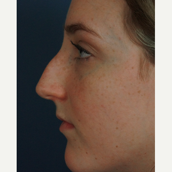 18-24 year old woman treated with Rhinoplasty before 3245055