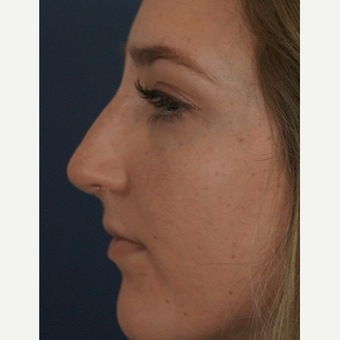 18-24 year old woman treated with Rhinoplasty after 3245055