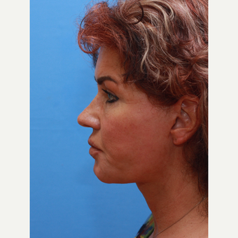 Lady treated with Neck Lift after 3373037