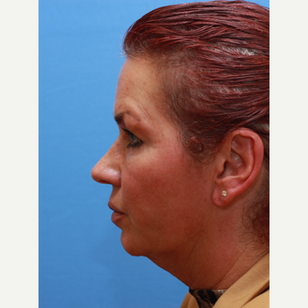 Lady treated with Neck Lift before 3373037
