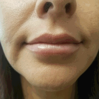 45-54 year old woman treated with Juvederm after 3658411