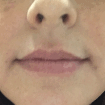 45-54 year old woman treated with Juvederm before 3658411