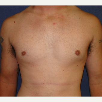 18-24 year old man treated with Male Breast Reduction after 3241111