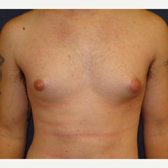18-24 year old man treated with Male Breast Reduction before 3241111