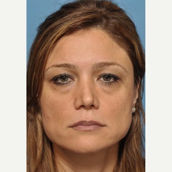 Bruiseless Cheek and Tear Trough Fillers - Microcannula Technique before 1636007