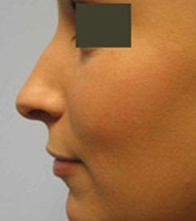 Rhinoplasty before 132701