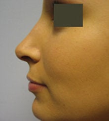 Rhinoplasty after 132701