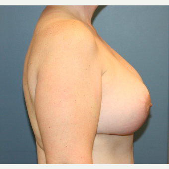 Breast Implants With Lift after 3610212